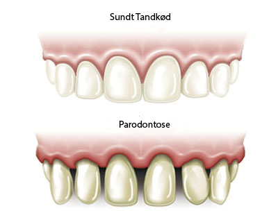 parodontose